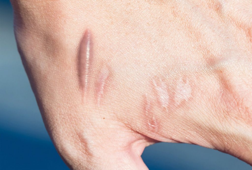 Keloid Nedir